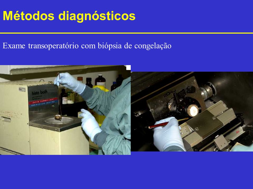 Métodos diagnósticos Exame transoperatório com biópsia de congelação