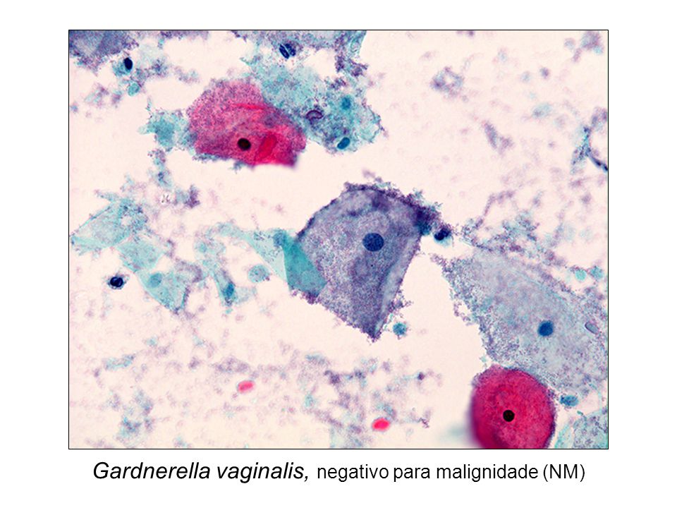 Gardnerella vaginalis, negativo para malignidade (NM) .