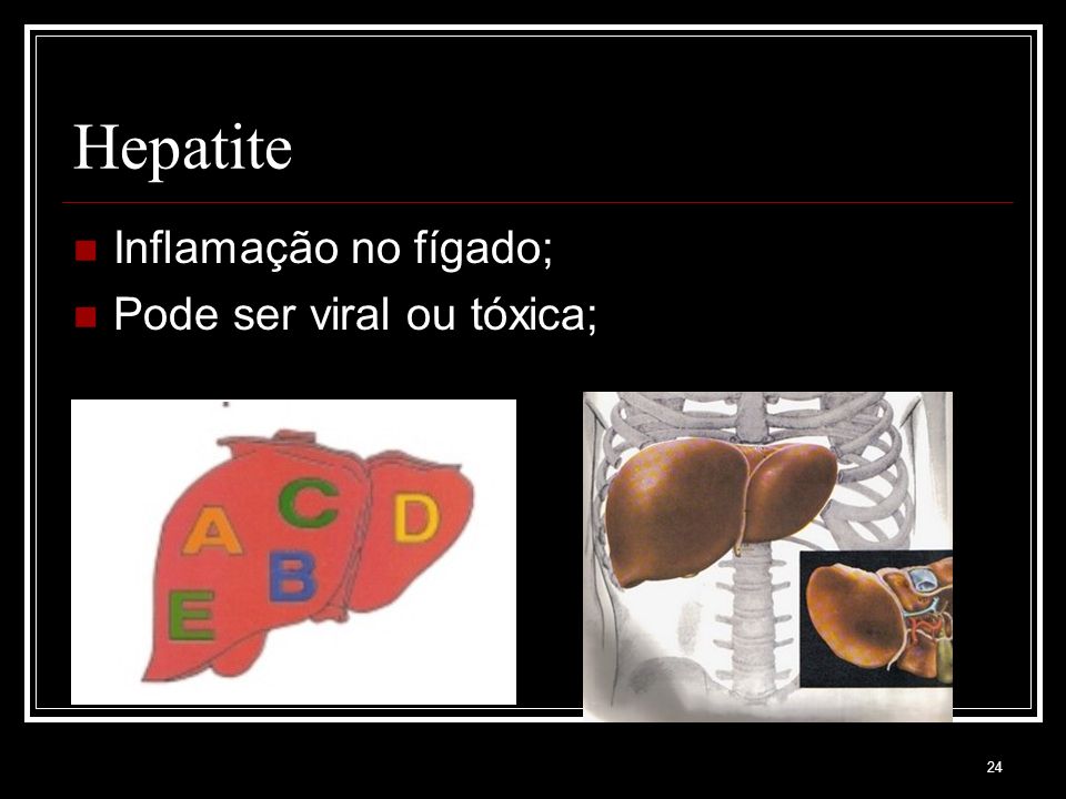 Hepatite Inflamação no fígado; Pode ser viral ou tóxica;