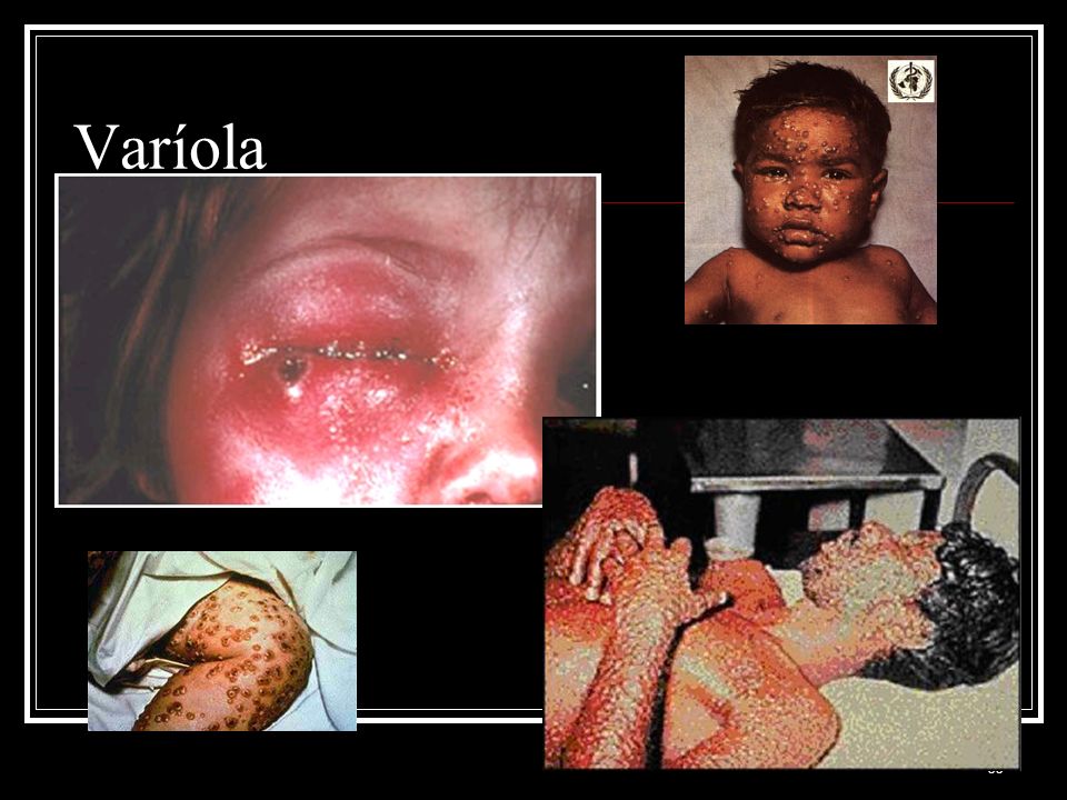 Varíola