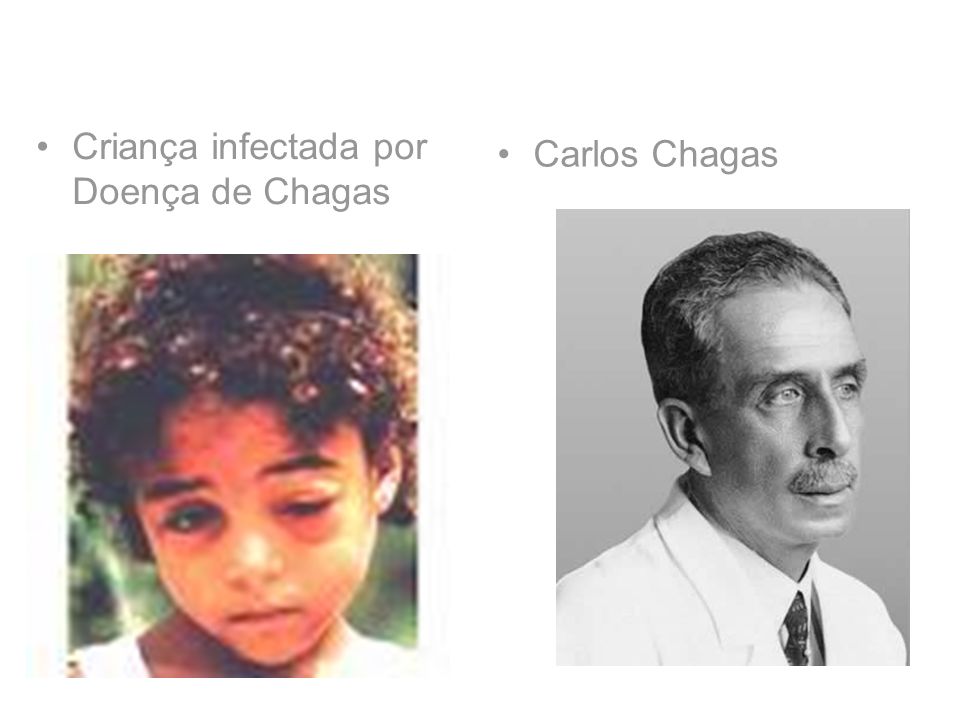 Criança infectada por Doença de Chagas