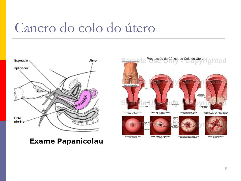Cancro do colo do útero Exame Papanicolau