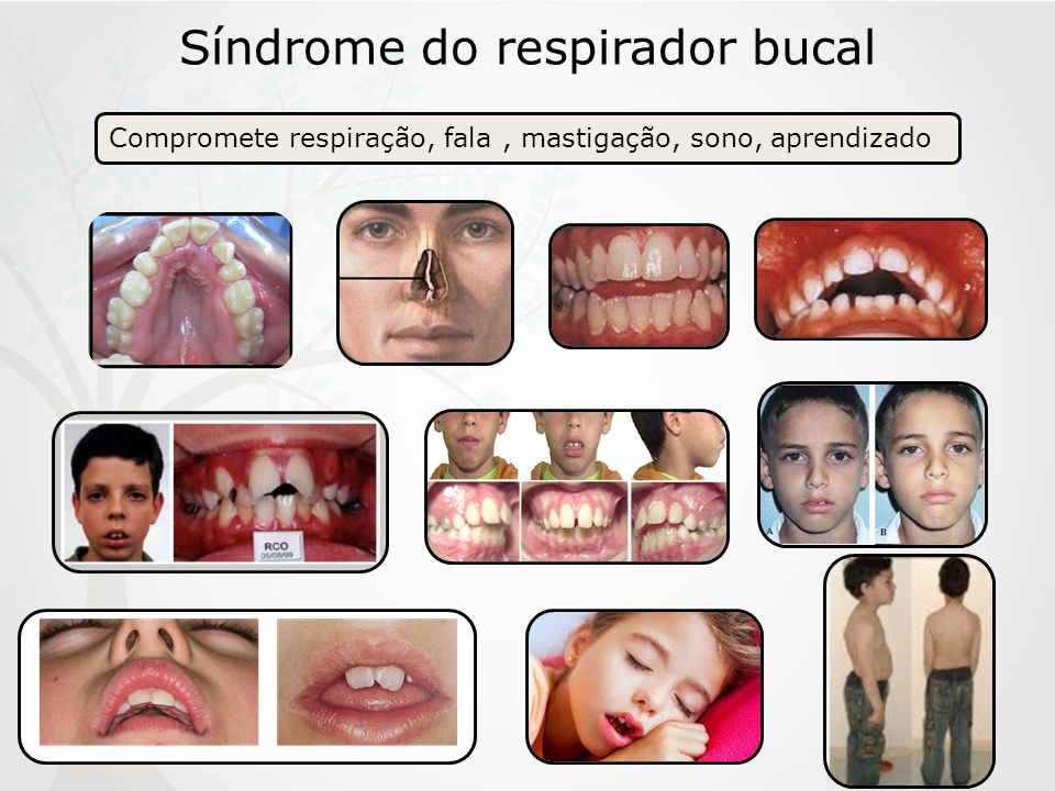Síndrome do respirador bucal