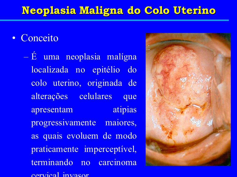 Neoplasia Maligna do Colo Uterino