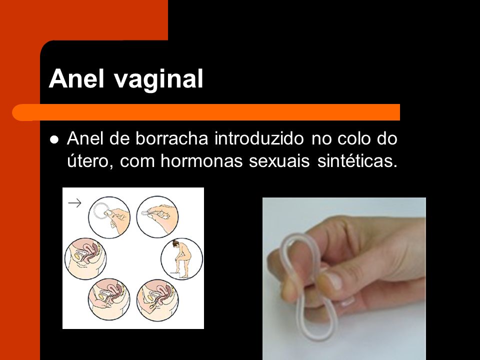 Anel vaginal Anel de borracha introduzido no colo do útero, com hormonas sexuais sintéticas.