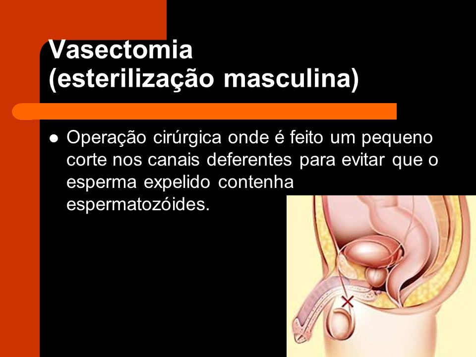 Vasectomia (esterilização masculina)