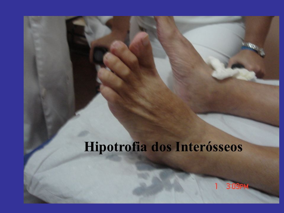 Hipotrofia dos Interósseos
