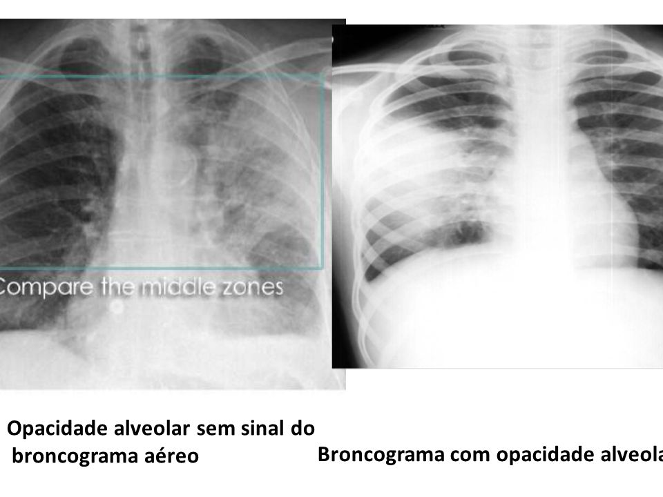 Opacidade alveolar sem sinal do broncograma aéreo