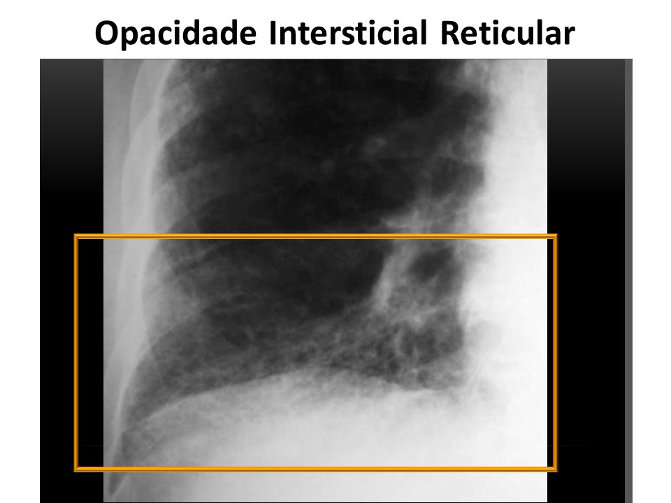 Opacidade Intersticial Reticular