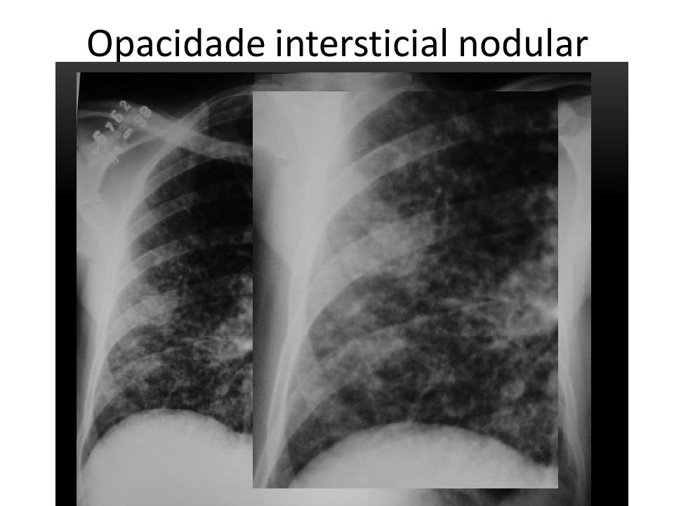 Opacidade intersticial nodular