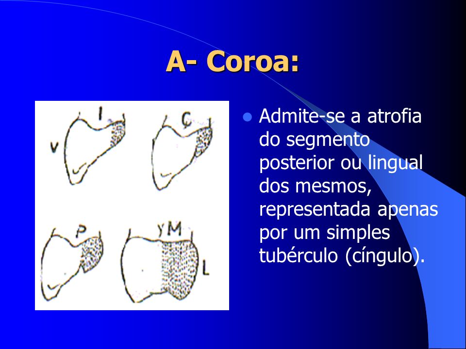 A- Coroa: Admite-se a atrofia do segmento posterior ou lingual dos mesmos, representada apenas por um simples tubérculo (cíngulo).