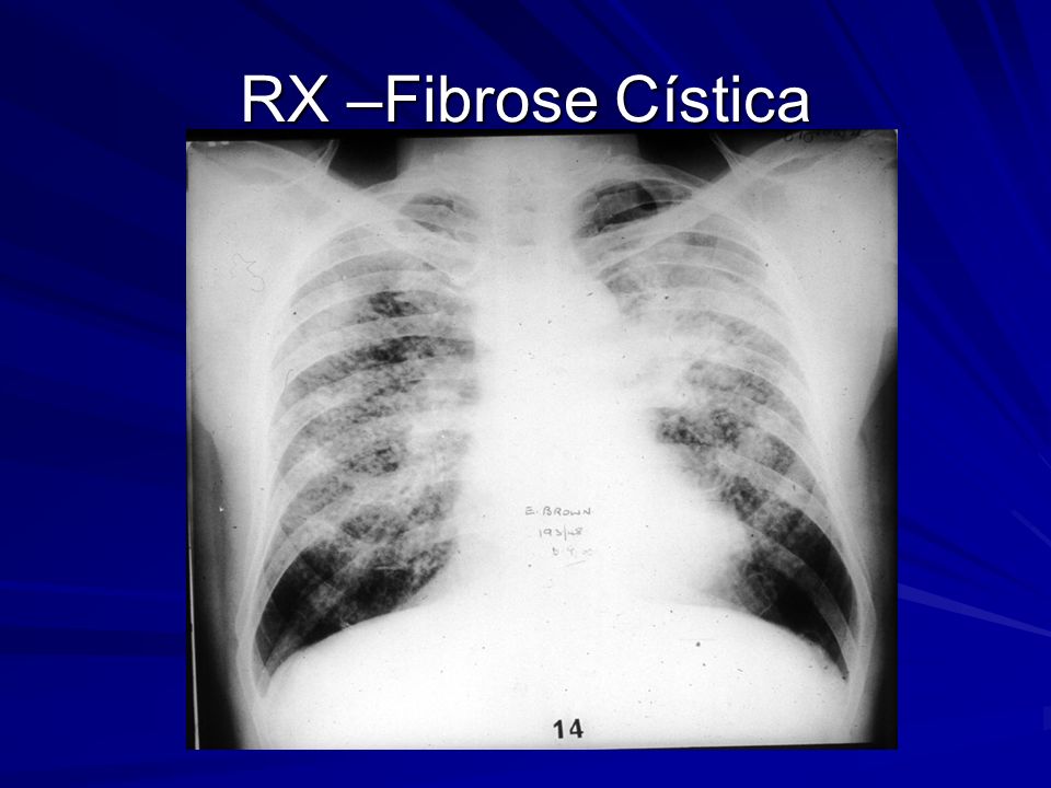 RX –Fibrose Cística