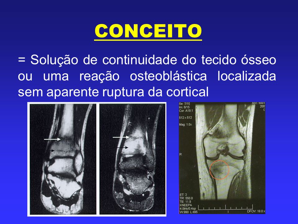 CONCEITO = Solução de continuidade do tecido ósseo ou uma reação osteoblástica localizada sem aparente ruptura da cortical.