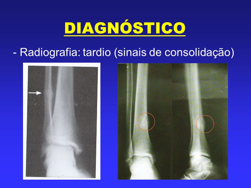 DIAGNÓSTICO - Radiografia: tardio (sinais de consolidação)