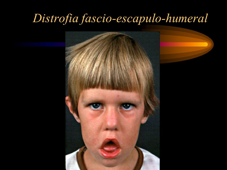 Distrofia fascio-escapulo-humeral