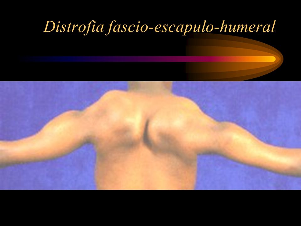 Distrofia fascio-escapulo-humeral