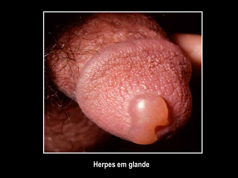Herpes em glande