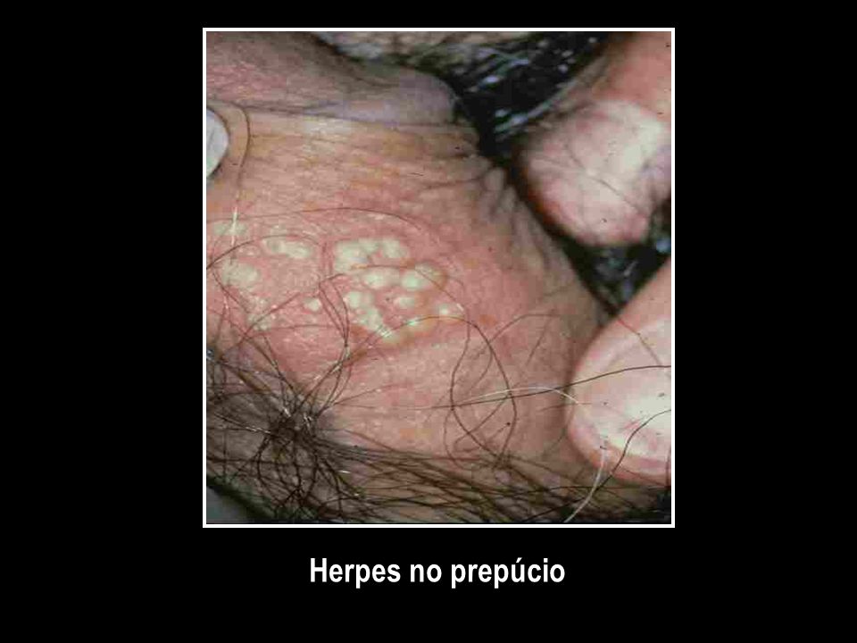 Herpes no prepúcio