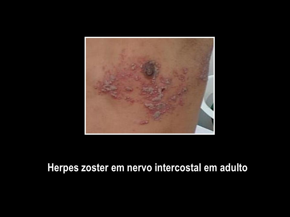Herpes zoster em nervo intercostal em adulto