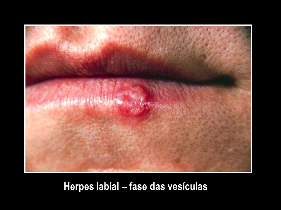 Herpes labial – fase das vesículas
