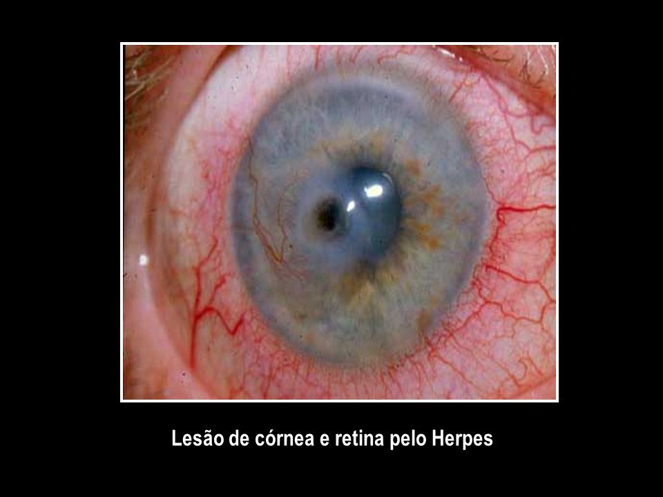 Lesão de córnea e retina pelo Herpes