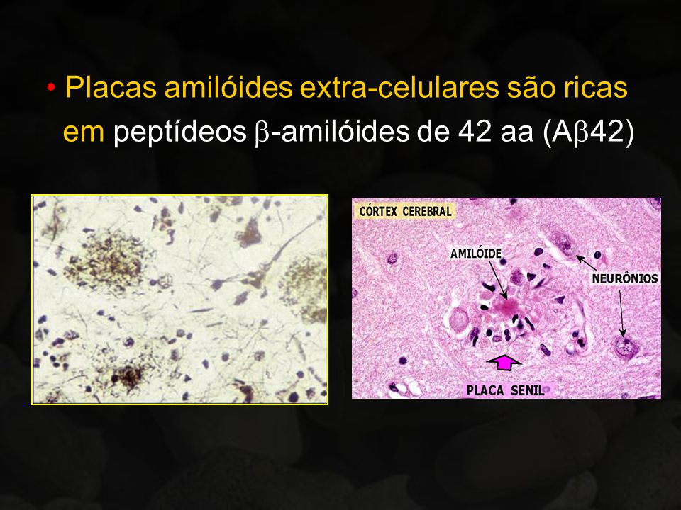 Placas amilóides extra-celulares são ricas