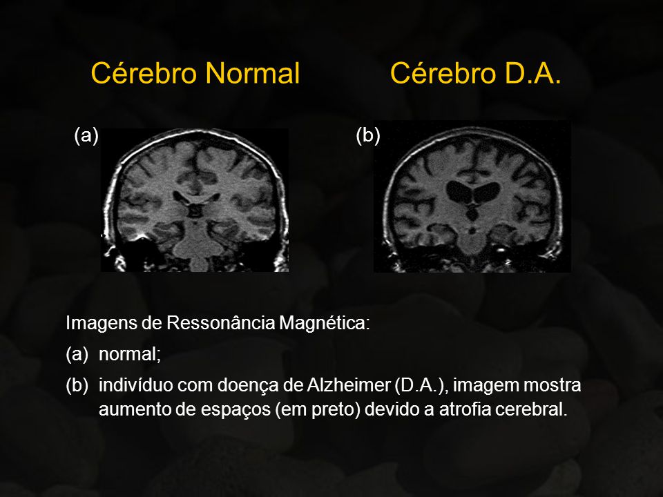 Cérebro Normal Cérebro D.A. (a) (b) Imagens de Ressonância Magnética: