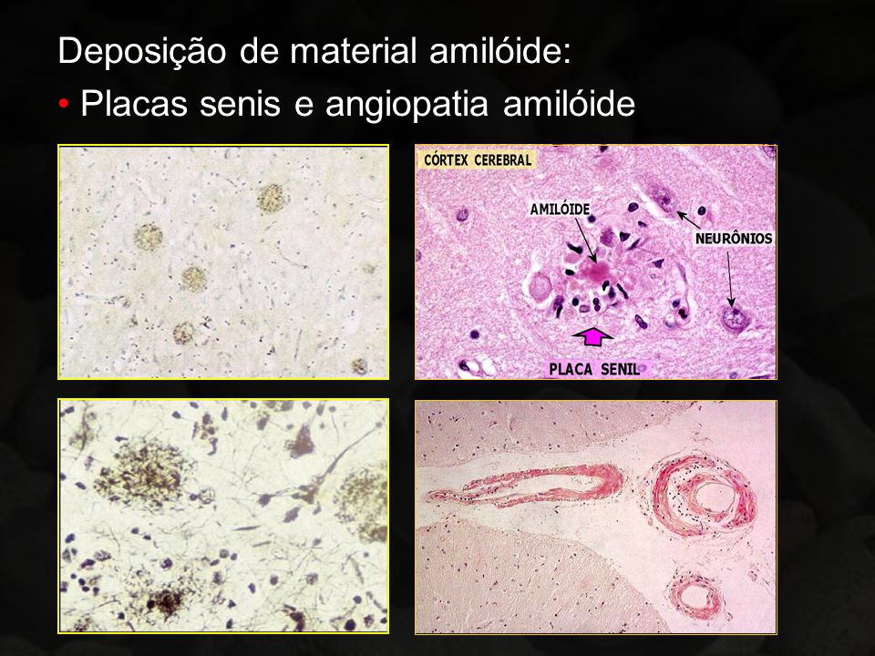 Deposição de material amilóide: Placas senis e angiopatia amilóide