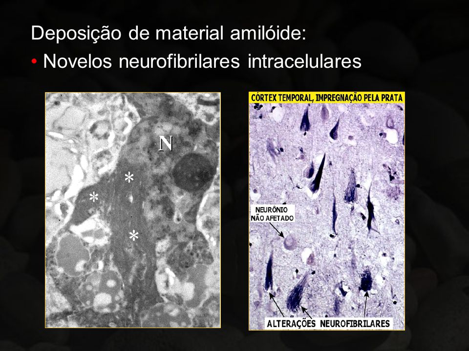 Deposição de material amilóide: Novelos neurofibrilares intracelulares