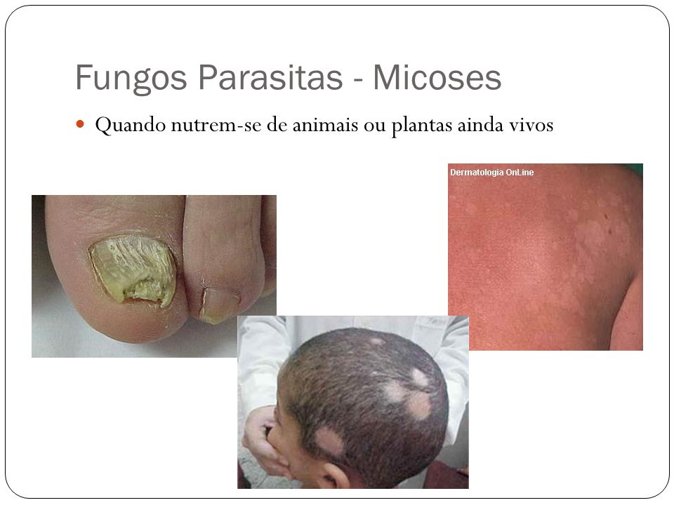Fungos Parasitas - Micoses