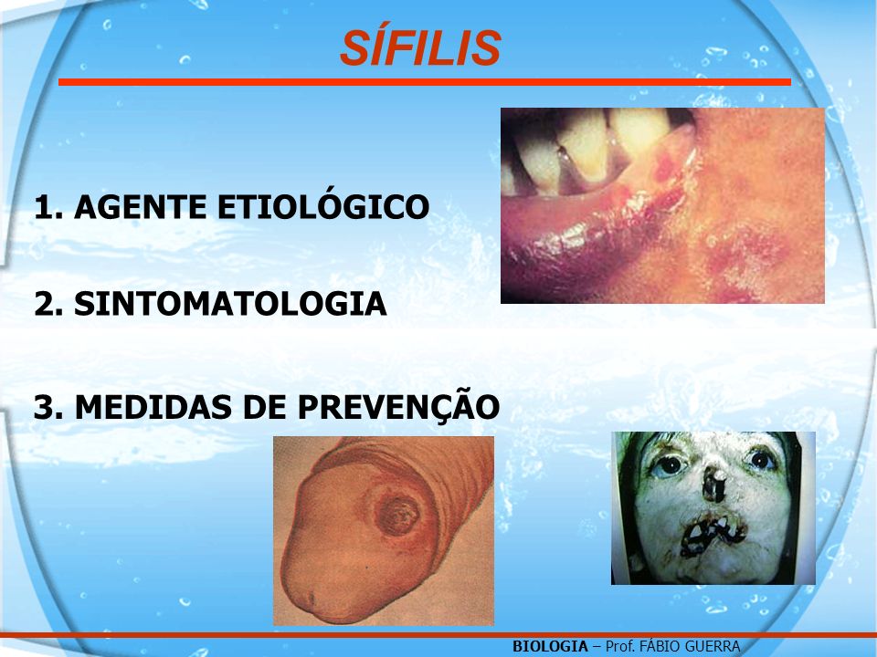 SÍFILIS 1. AGENTE ETIOLÓGICO 2. SINTOMATOLOGIA 3. MEDIDAS DE PREVENÇÃO
