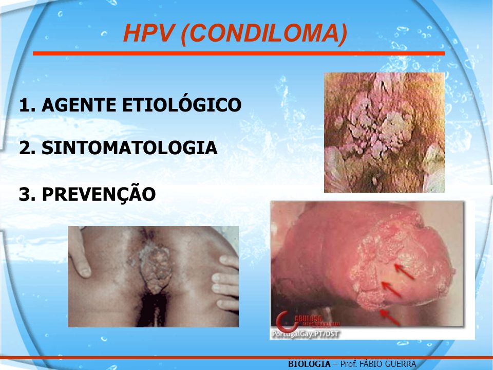 HPV (CONDILOMA) 1. AGENTE ETIOLÓGICO 2. SINTOMATOLOGIA 3. PREVENÇÃO