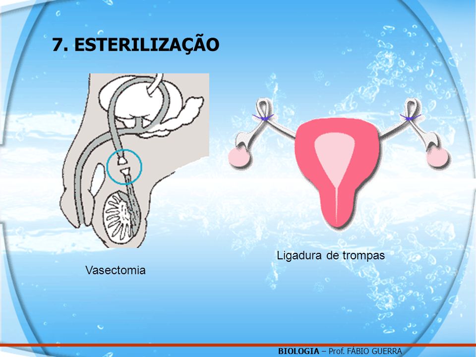 7. ESTERILIZAÇÃO Vasectomia Ligadura de trompas