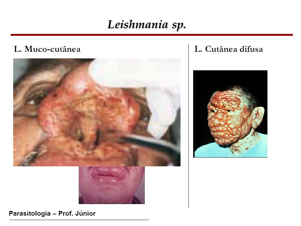 Leishmania sp. L. Muco-cutânea L. Cutânea difusa
