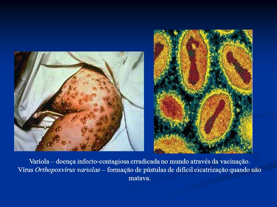 Varíola – doença infecto-contagiosa erradicada no mundo através da vacinação.