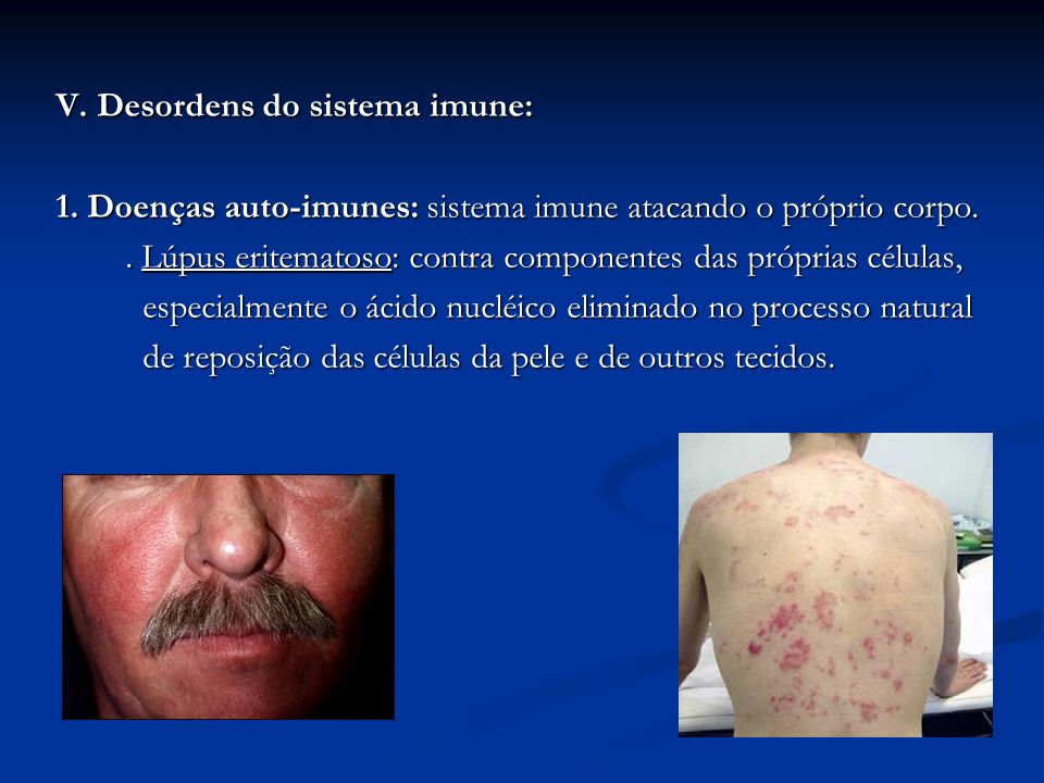V. Desordens do sistema imune: