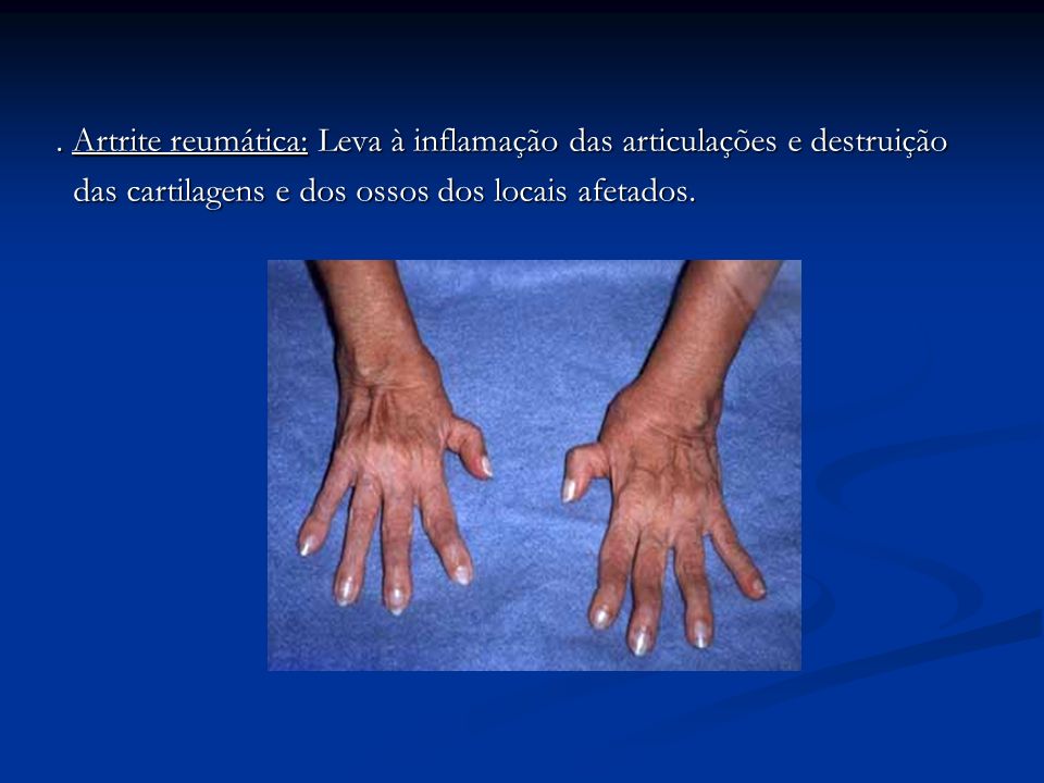 . Artrite reumática: Leva à inflamação das articulações e destruição