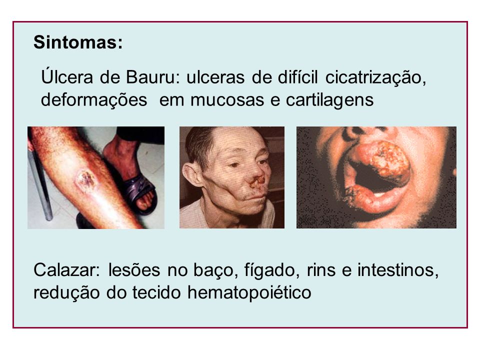 Sintomas: Úlcera de Bauru: ulceras de difícil cicatrização, deformações em mucosas e cartilagens.