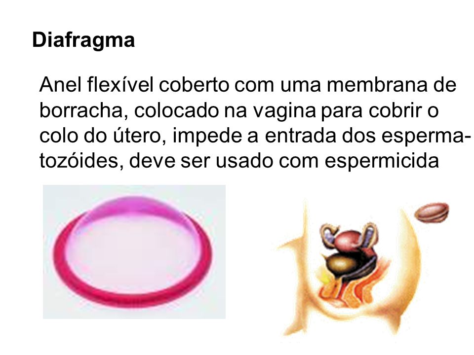 Diafragma Anel flexível coberto com uma membrana de. borracha, colocado na vagina para cobrir o. colo do útero, impede a entrada dos esperma-