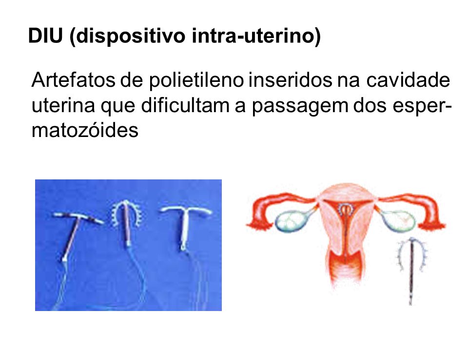DIU (dispositivo intra-uterino)