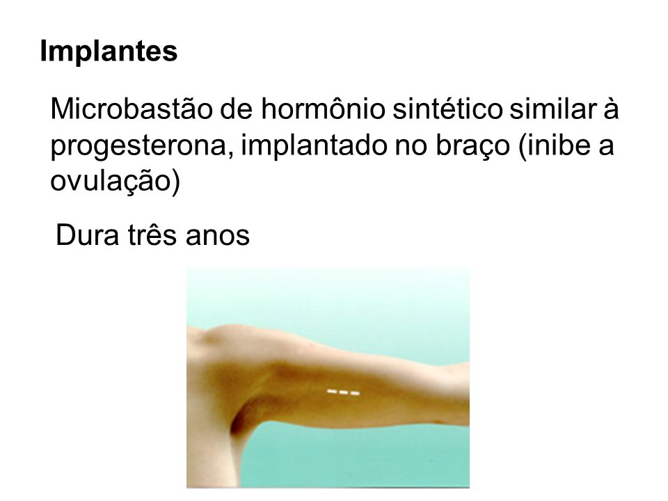 Implantes Microbastão de hormônio sintético similar à. progesterona, implantado no braço (inibe a.