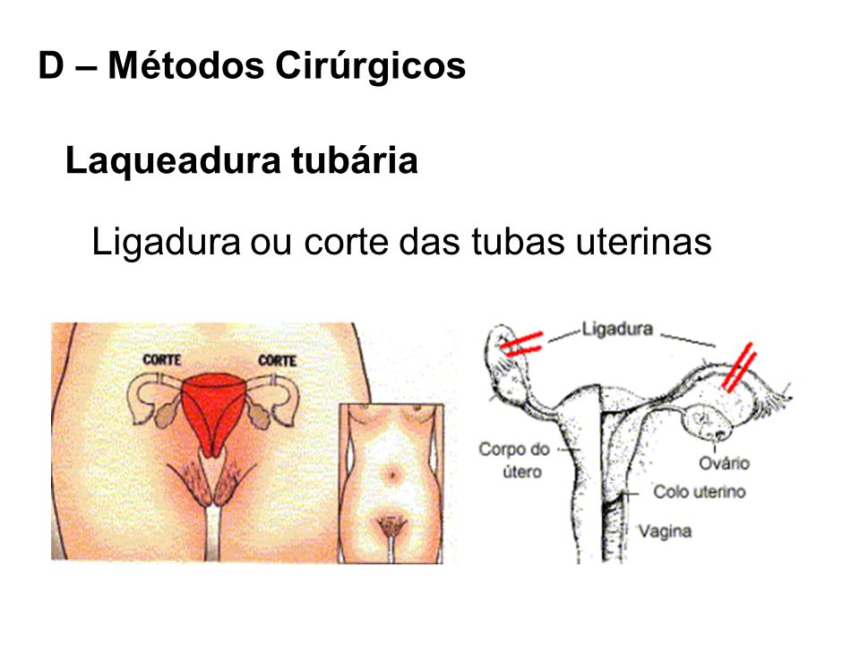 D – Métodos Cirúrgicos Laqueadura tubária Ligadura ou corte das tubas uterinas