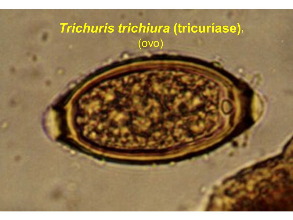 Trichuris trichiura (tricuríase) )