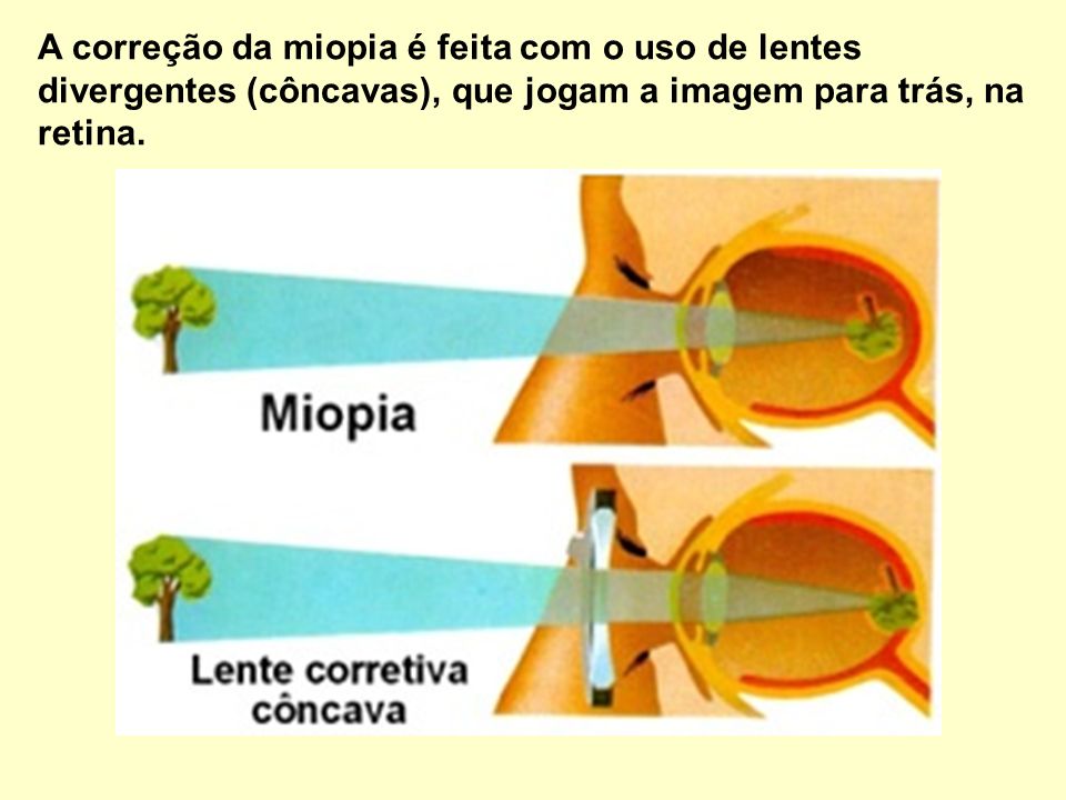 A correção da miopia é feita com o uso de lentes divergentes (côncavas), que jogam a imagem para trás, na retina.