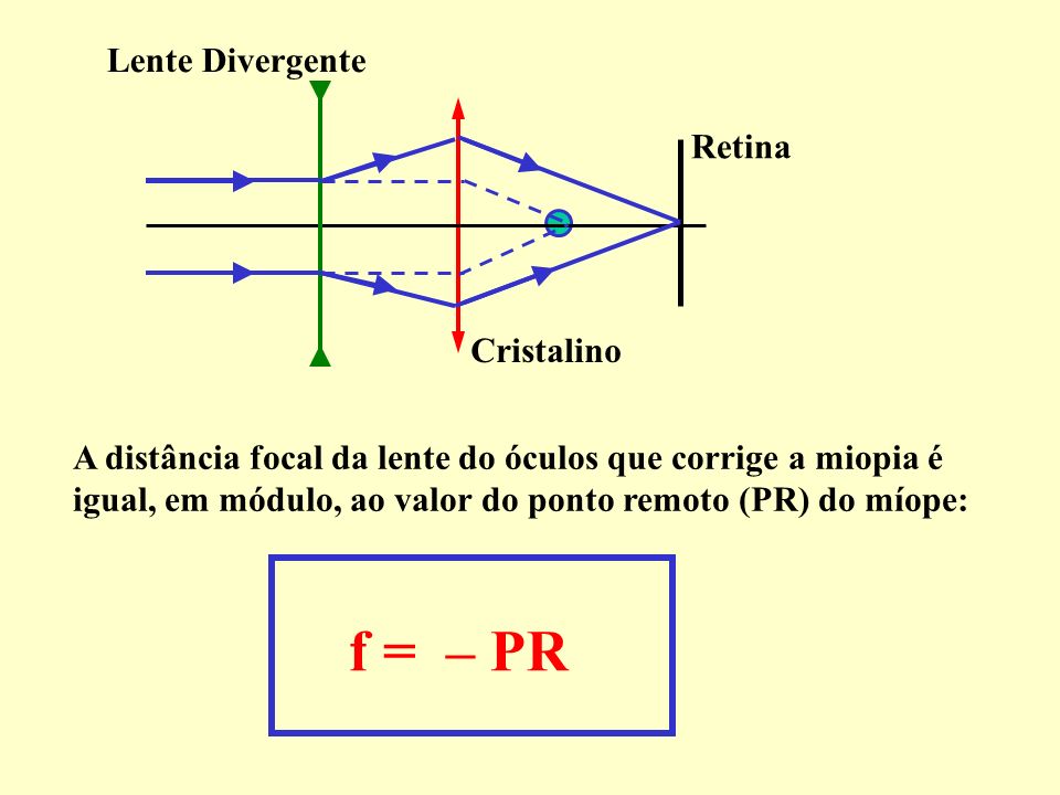 f = – PR Lente Divergente Retina Cristalino