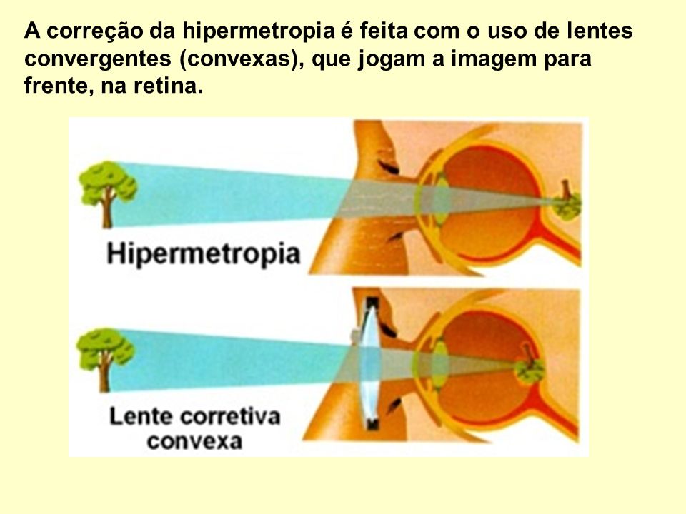 A correção da hipermetropia é feita com o uso de lentes convergentes (convexas), que jogam a imagem para frente, na retina.