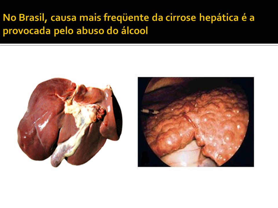No Brasil, causa mais freqüente da cirrose hepática é a provocada pelo abuso do álcool