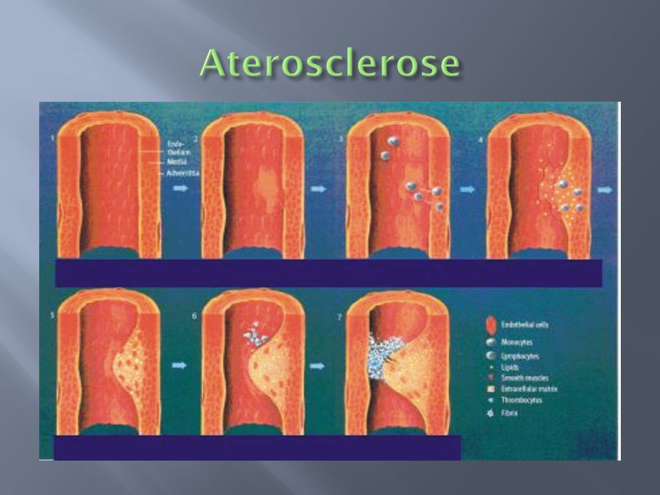 Aterosclerose