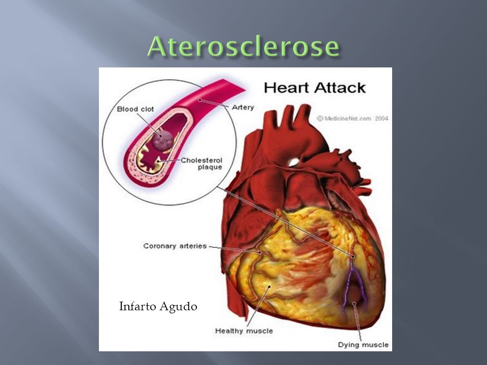 Aterosclerose Infarto Agudo