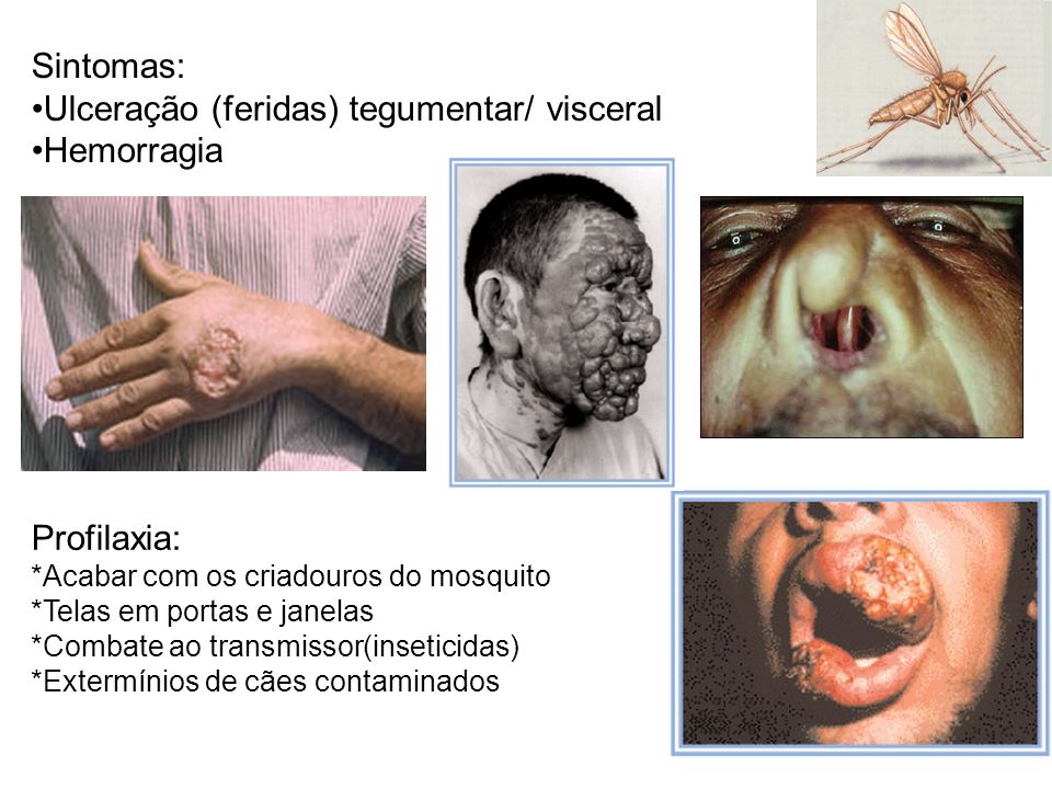 Ulceração (feridas) tegumentar/ visceral Hemorragia